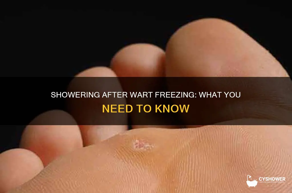 can you shower after getting a wart frozen