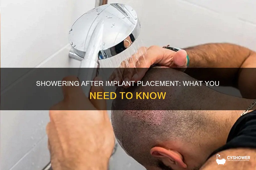 can you shower after getting the implant