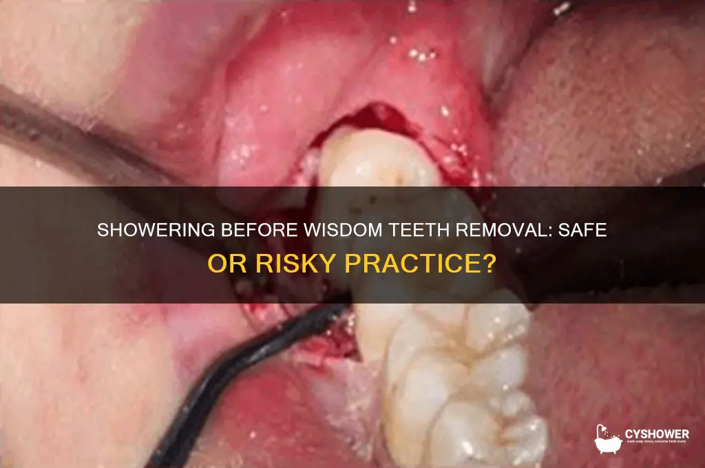 can you shower before getting your wisdom teeth out
