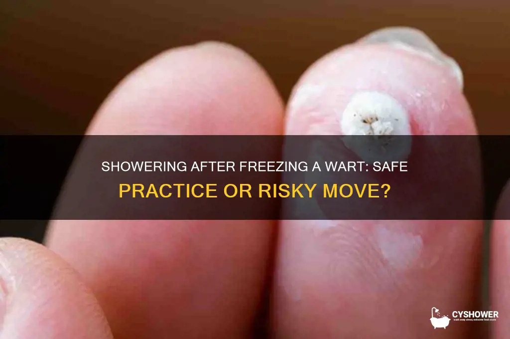can you take a shower after freezing a wart