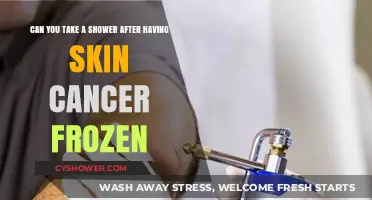 Showering After Skin Cancer Freezing: What You Need to Know