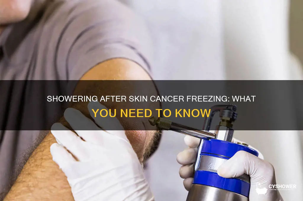 can you take a shower after having skin cancer frozen