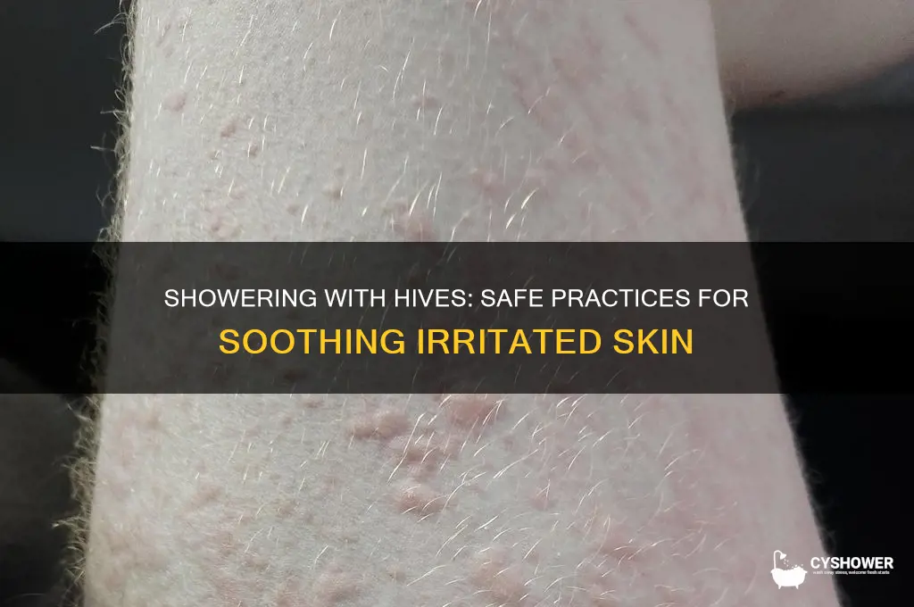 can you take a shower if you have hives