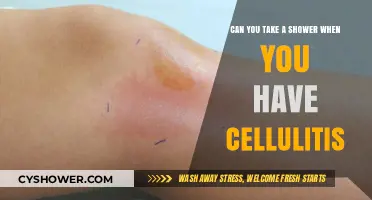Showering with Cellulitis: Safe Practices and Precautions to Follow