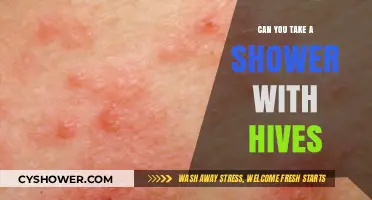 Showering with Hives: Safe Practices and Relief Tips for Itchy Skin