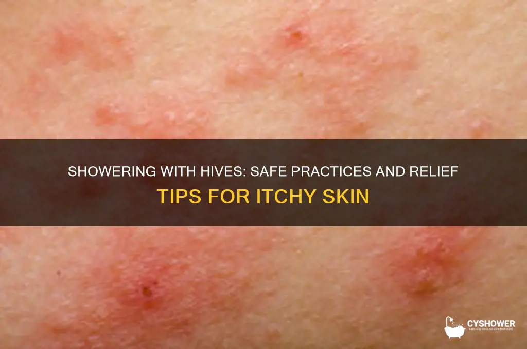 can you take a shower with hives