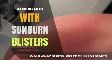 Sunburn Blisters and Showers: Safe Practices for Healing Skin