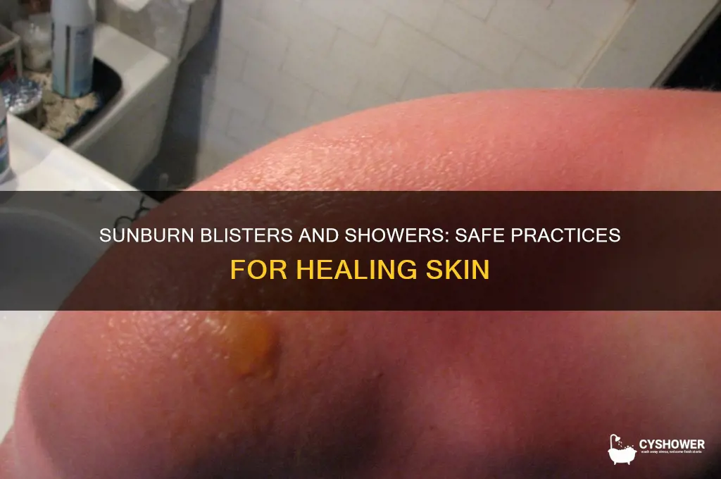 can you take a shower with sunburn blisters