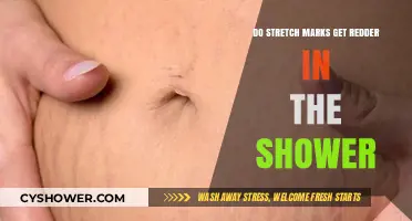 Why Stretch Marks May Appear Redder After Showering: Explained