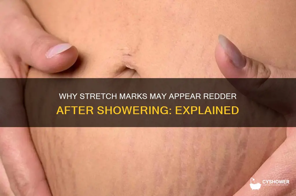 do stretch marks get redder in the shower