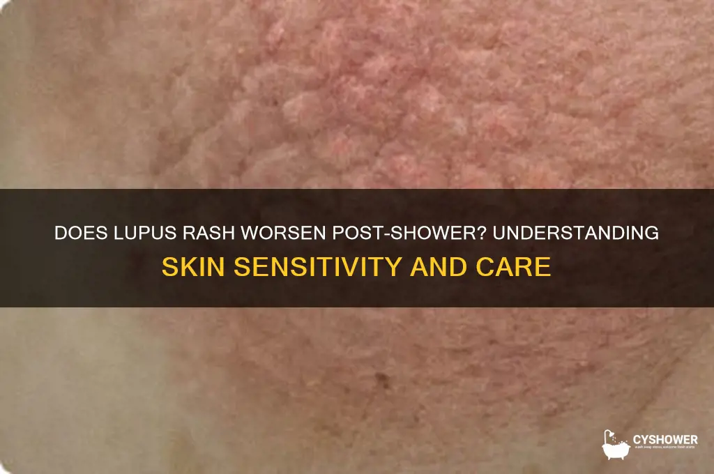 does lupus rash get worse after shower