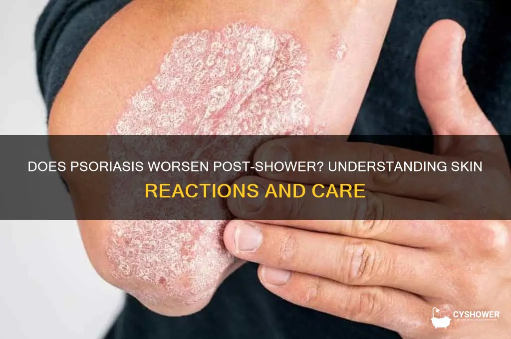 does psoriasis get worse after shower