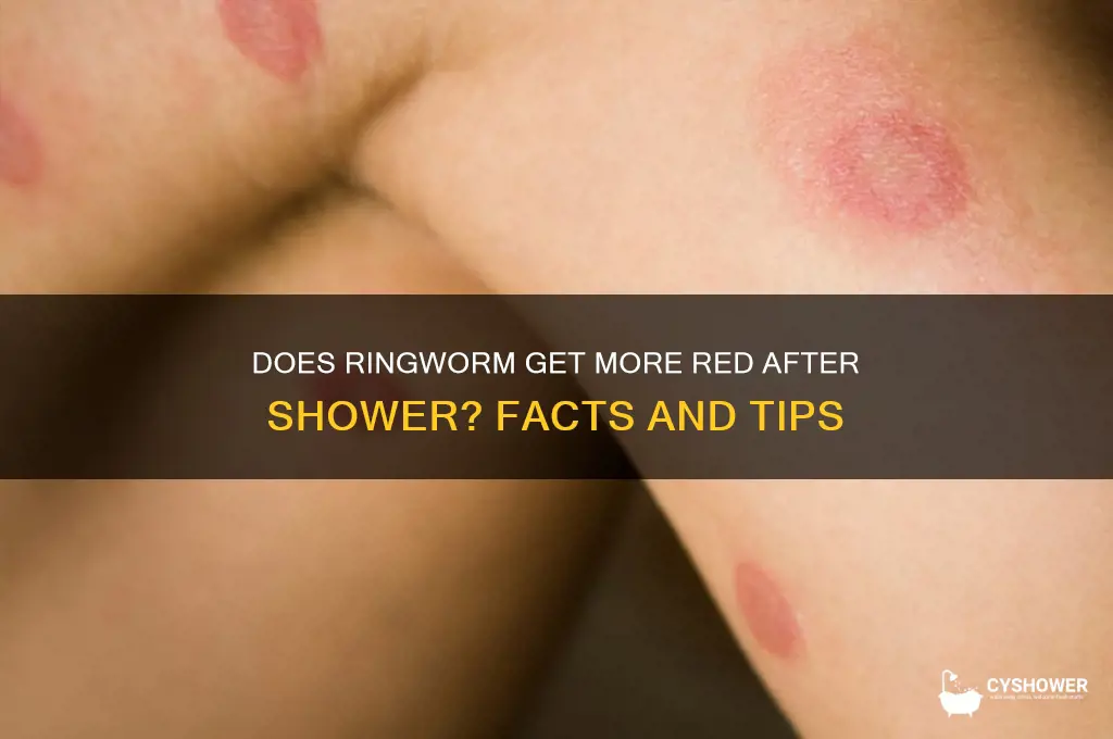 does ringworm get more red after shower