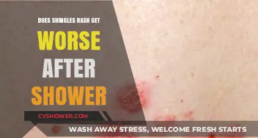 Shingles Rash After Shower: Does It Worsen or Improve?