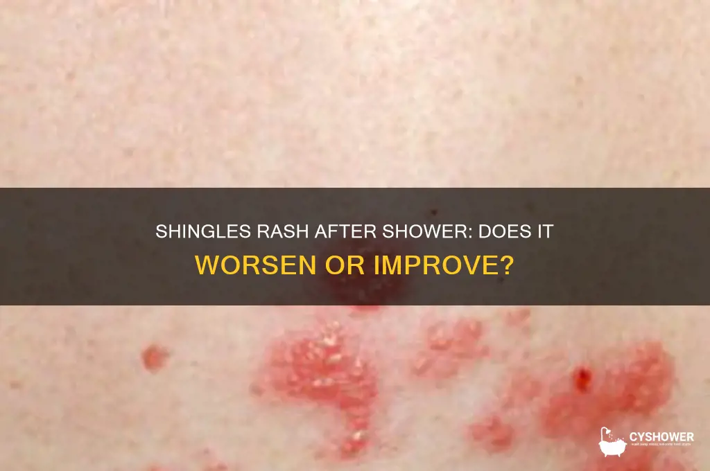 does shingles rash get worse after shower