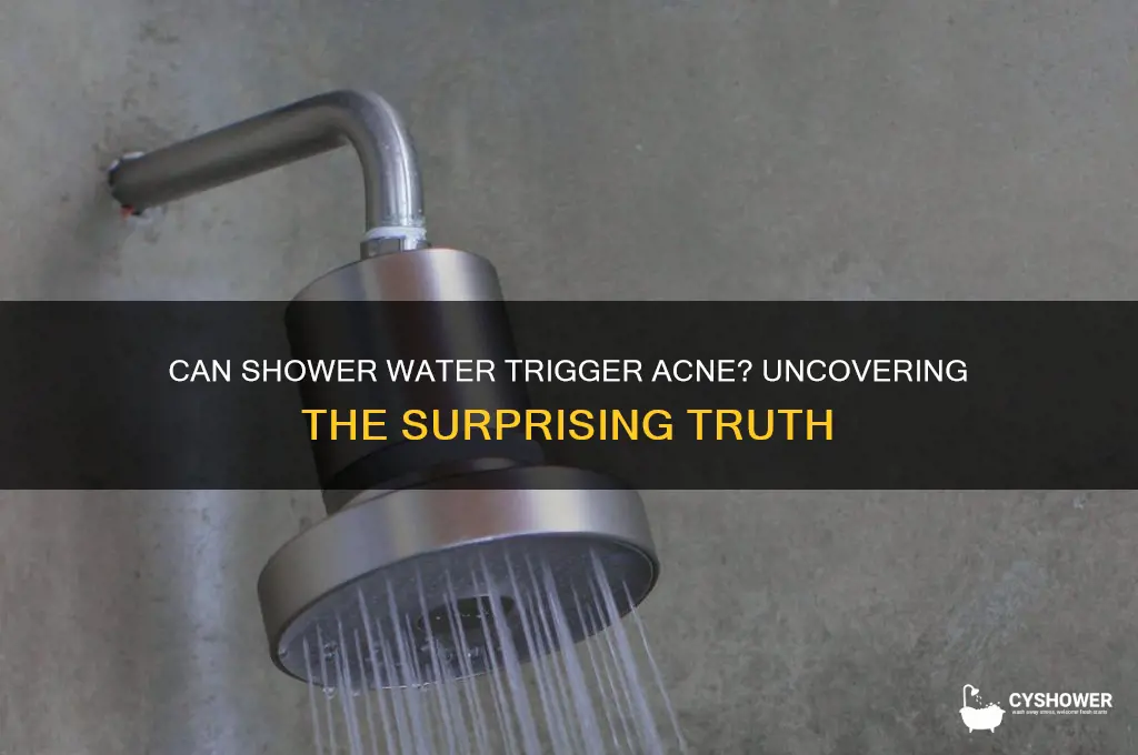 does shower water cause acne