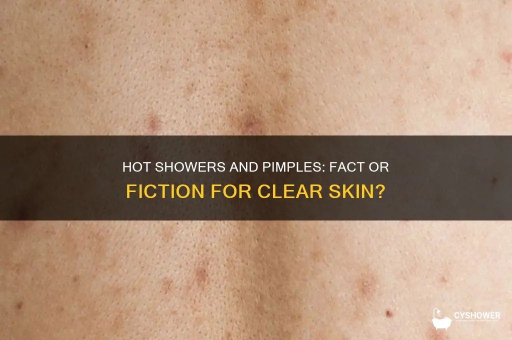does taking a hot shower get rid of pimples