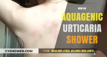Soothing Showers: Managing Aquagenic Urticaria Symptoms