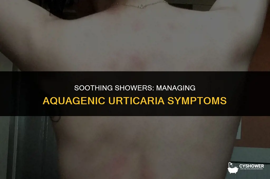 how do aquagenic urticaria shower