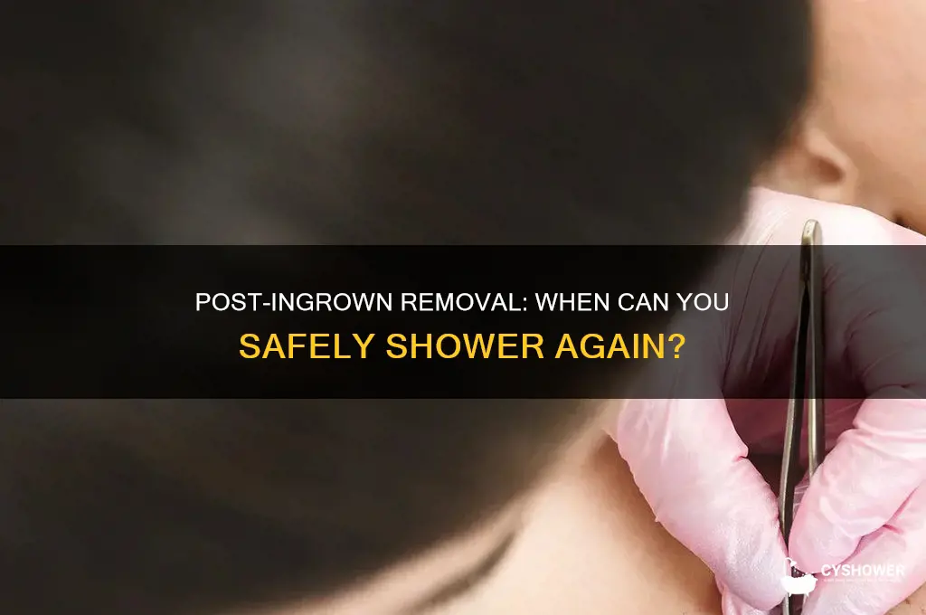 how long after getting ingrowns removed can you shower