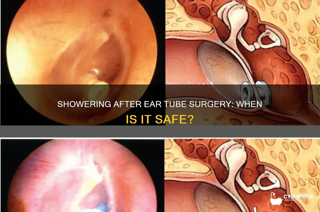 how long after getting tubes in ears can you shower