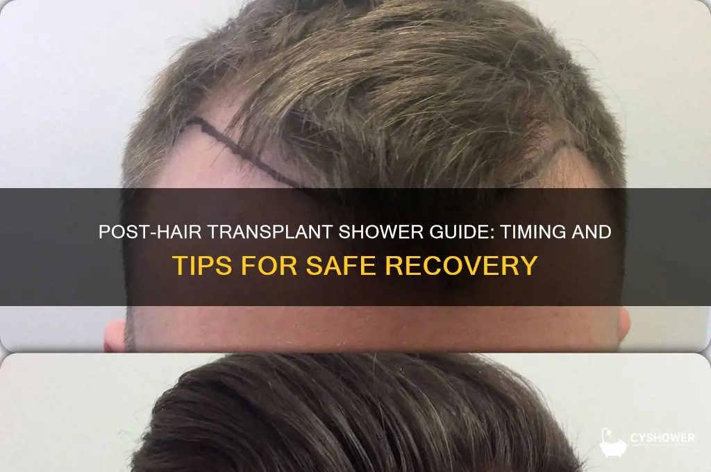 how soon can i shower after hair transplant