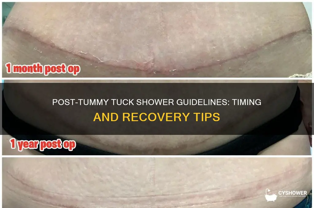 how soon can i shower after tummy tuck