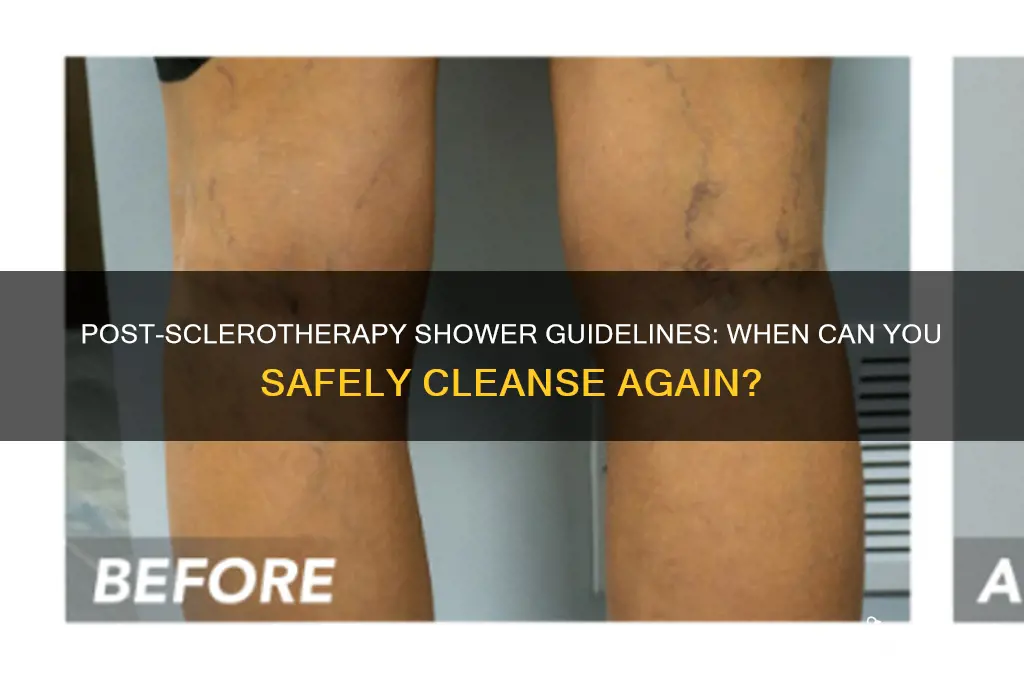how soon can you shower after sclerotherapy