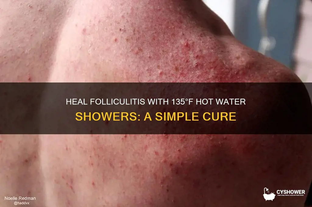how to cure folliculitis hot water 135 farenheit shower