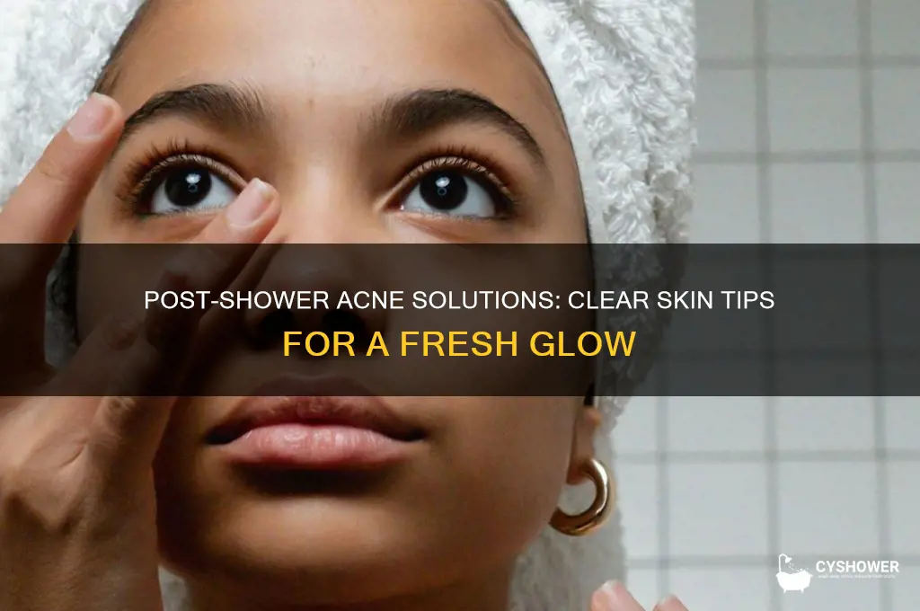 how to get rid of acne after a shower