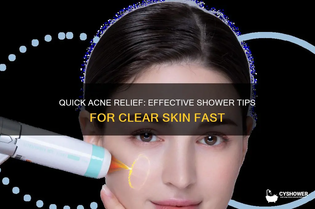 how to get rid of acne fast shower