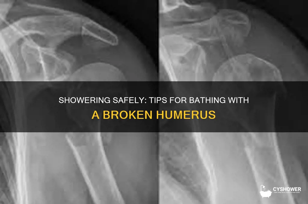 how to take a shower with a broken humerus