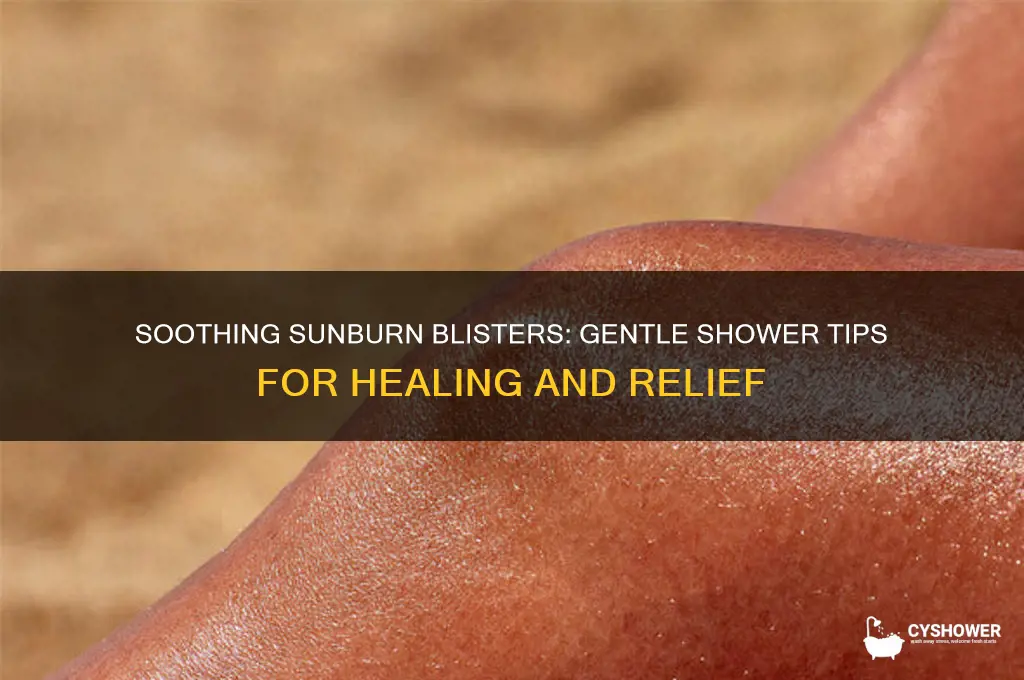 how to take a shower with sunburn blisters
