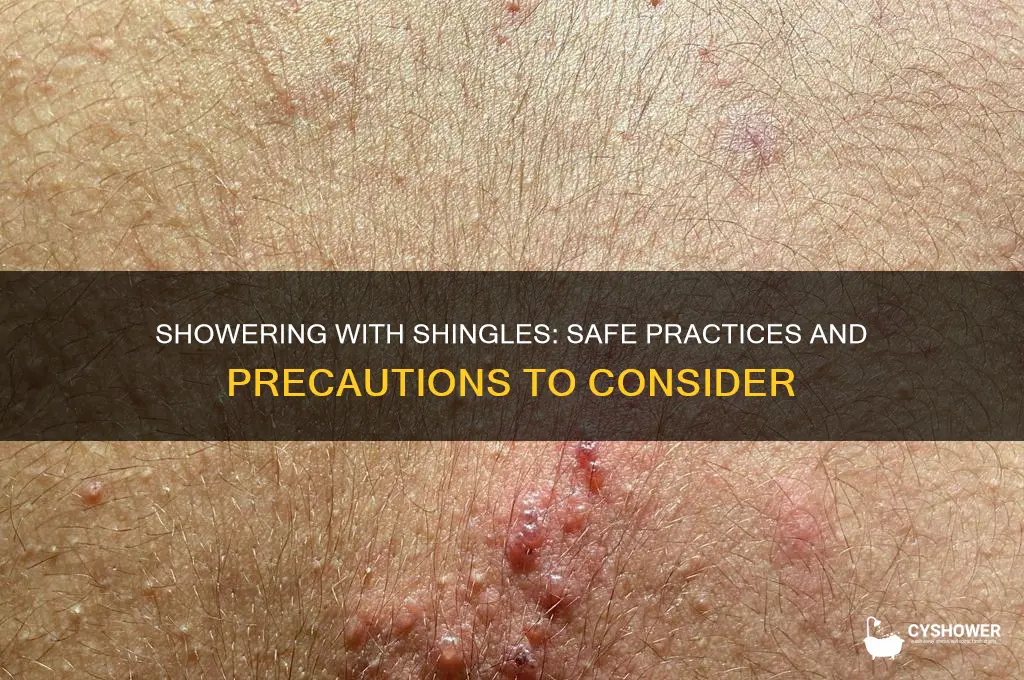 is it ok to take a shower with shingles