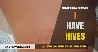 Hives and Showers: Should You Cleanse or Avoid Irritation?