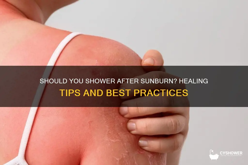 should you shower after getting a sunburn