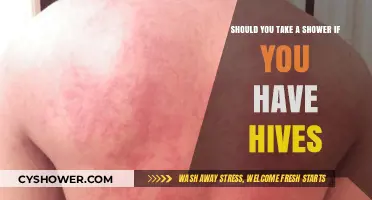Hives and Showers: Should You Cleanse or Avoid Irritation?