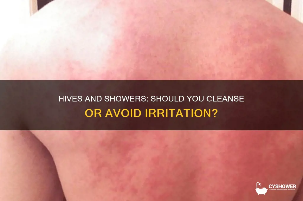should you take a shower if you have hives