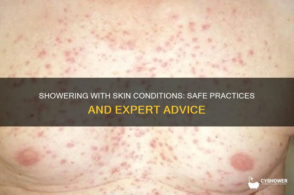 should you take a shower with skin disease