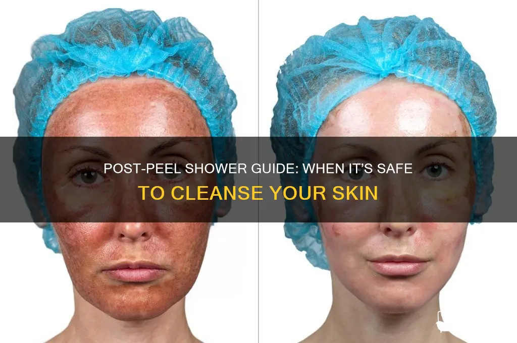 when can i shower after a chemical peel