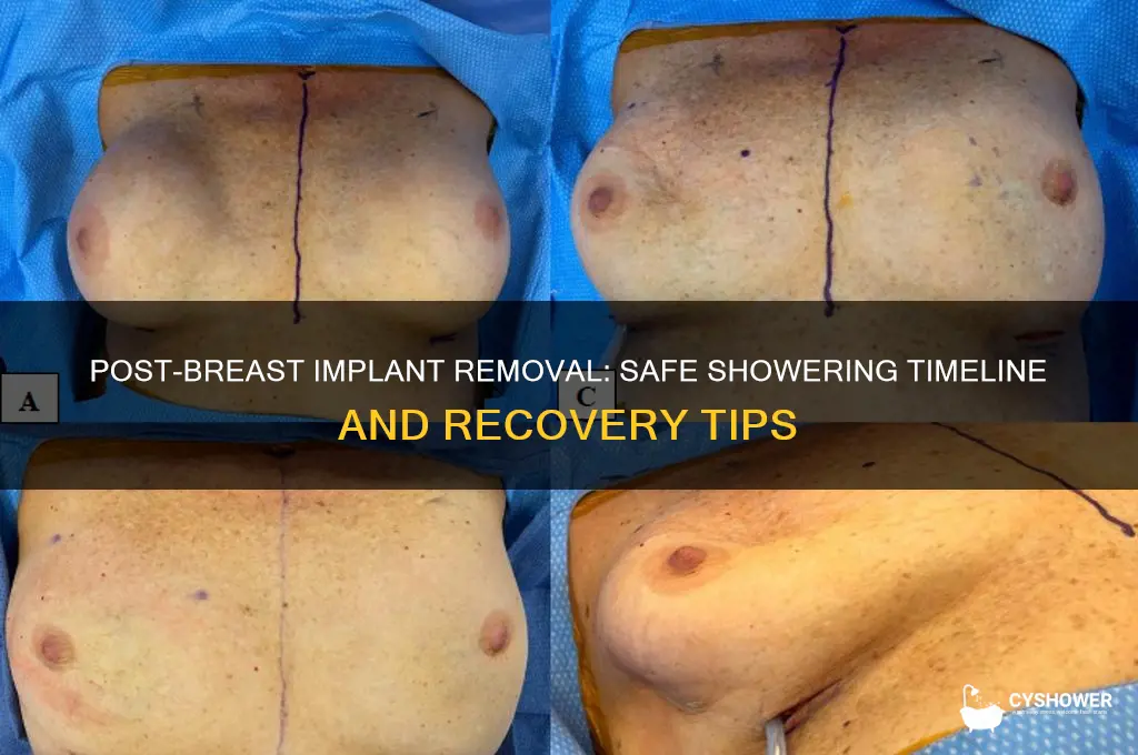 when can i shower after breast implant removal