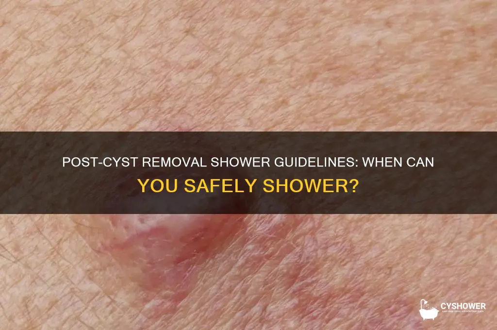 when can i shower after cyst removal