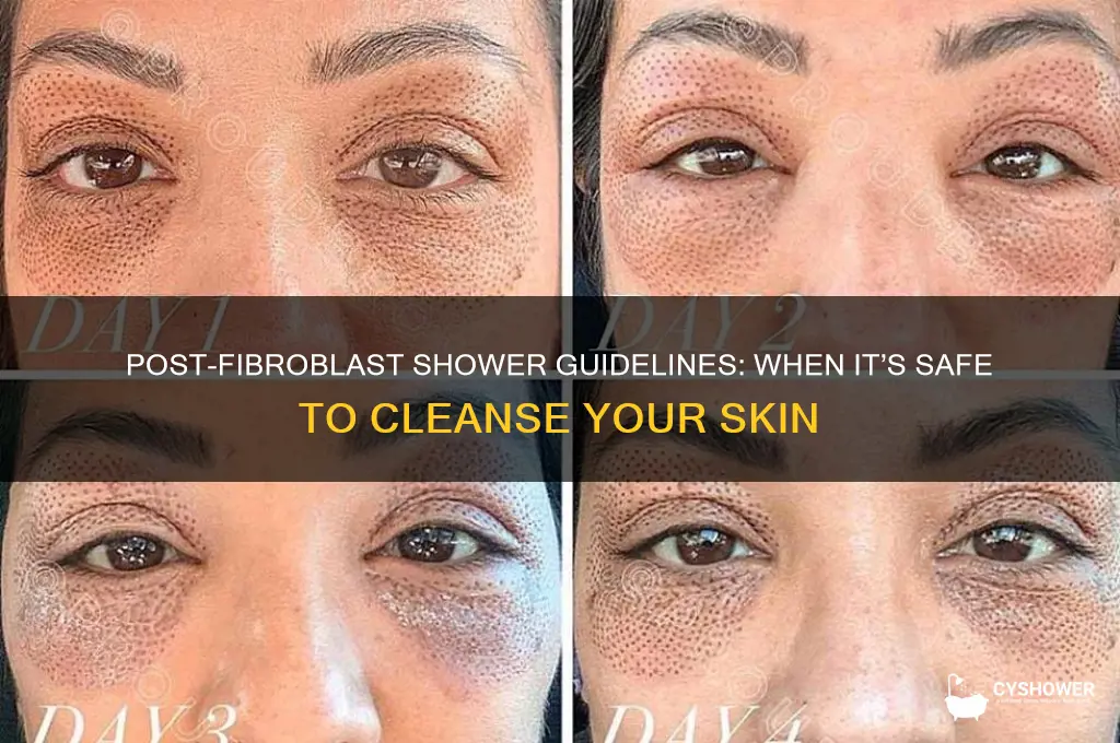 when can i shower after fibroblast