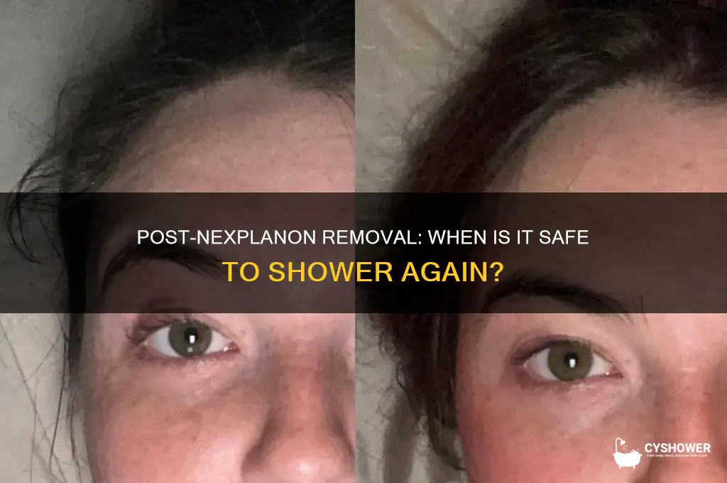 when can i shower after getting nexplanon removed