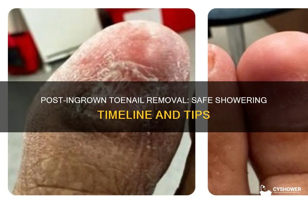when can i shower after ingrown toenail removal