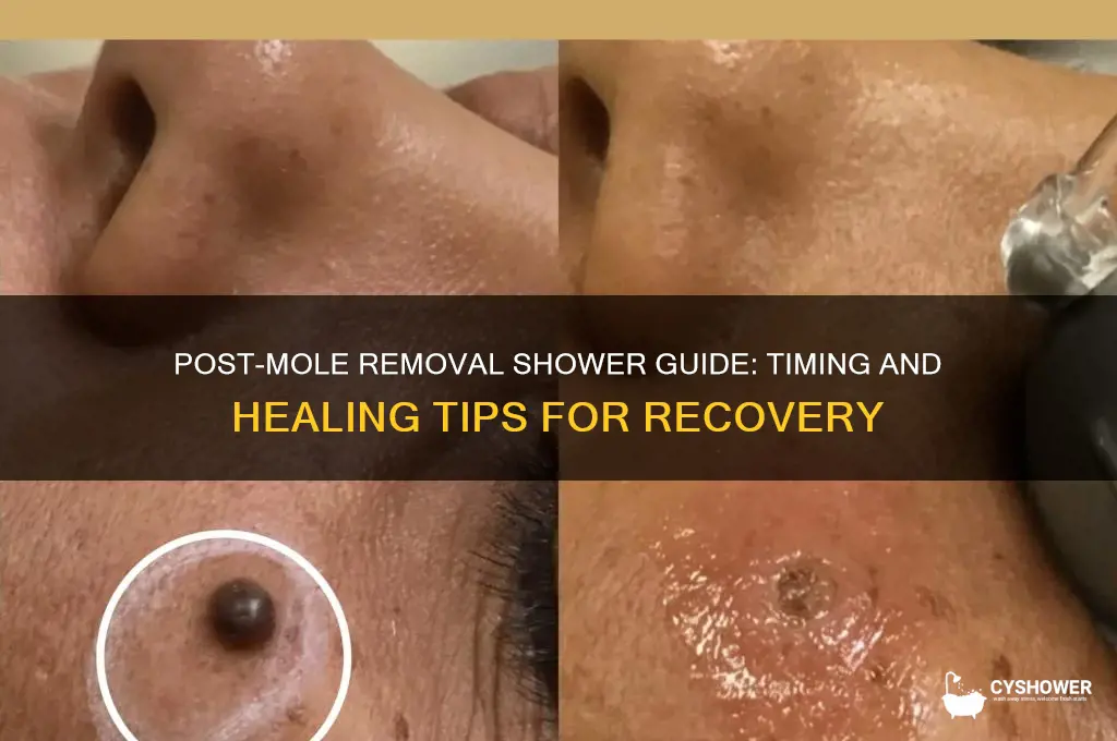 when can i shower after mole removal