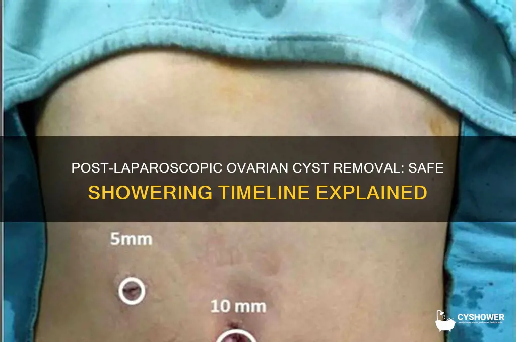 when can i shower after ovarian cyst removal laparoscopic surgery