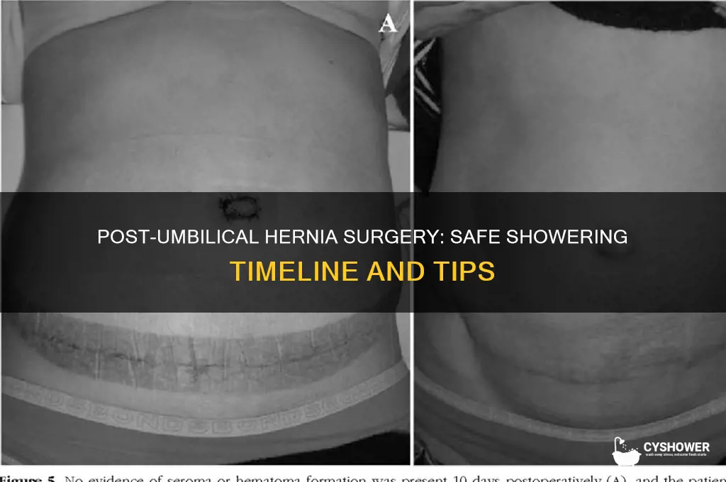 when can i shower after umbilical hernia surgery