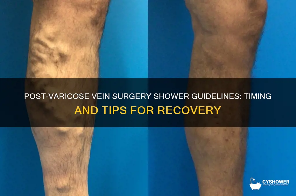 when can i shower after varicose vein surgery