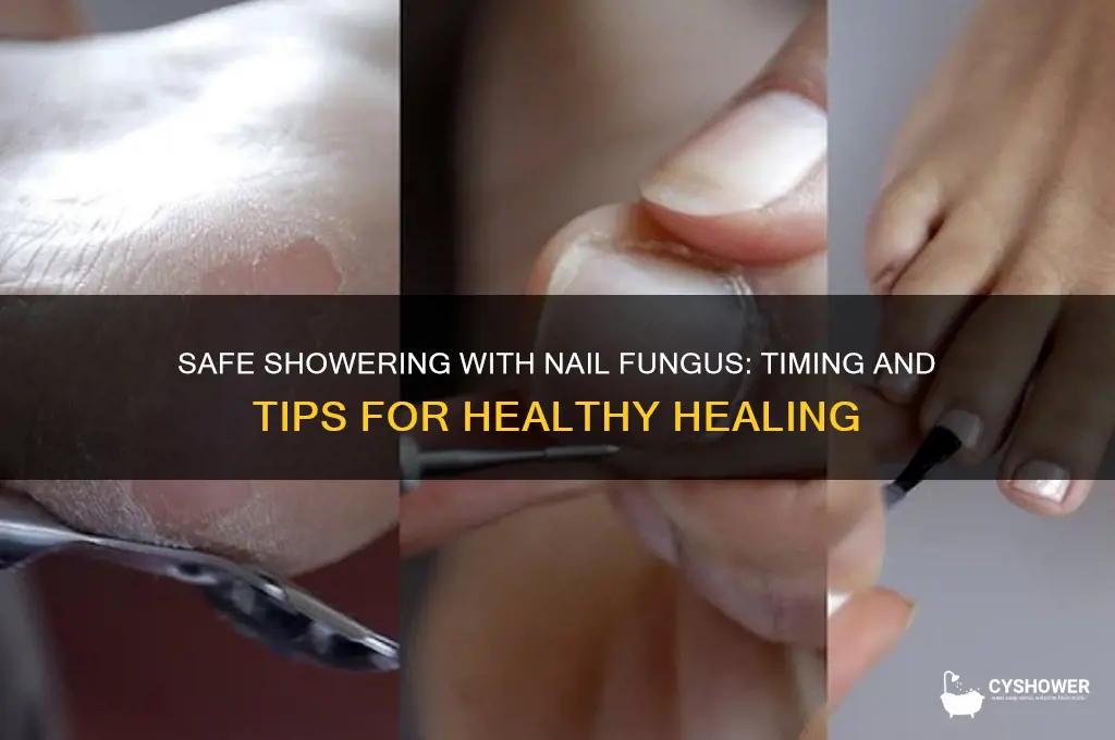 when can i take a shower with nail fungus